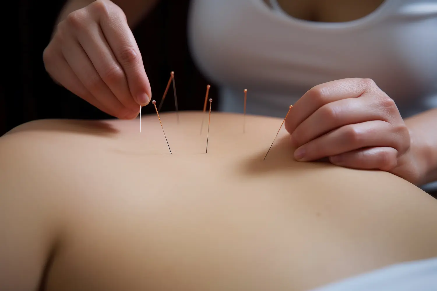 Acupuncture